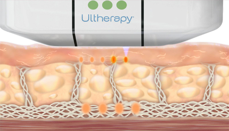 How the Ultherapy Works