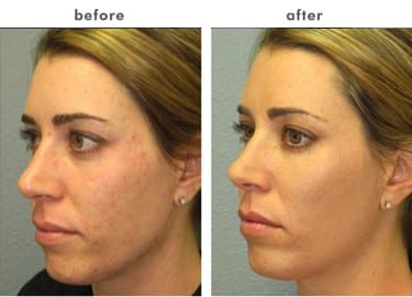 vi peel before and after