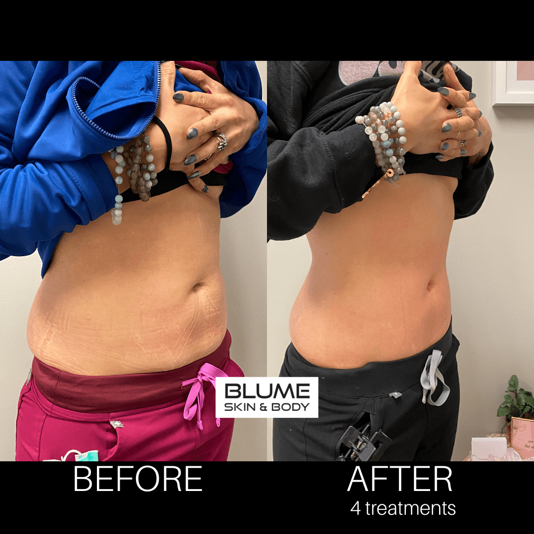 BlumeSculpt Pt. 3 Before and after front side b