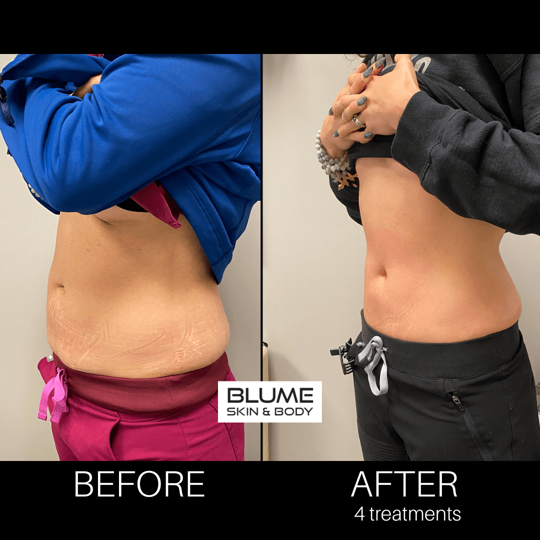 BlumeSculpt Pt. 3 Before and after side a